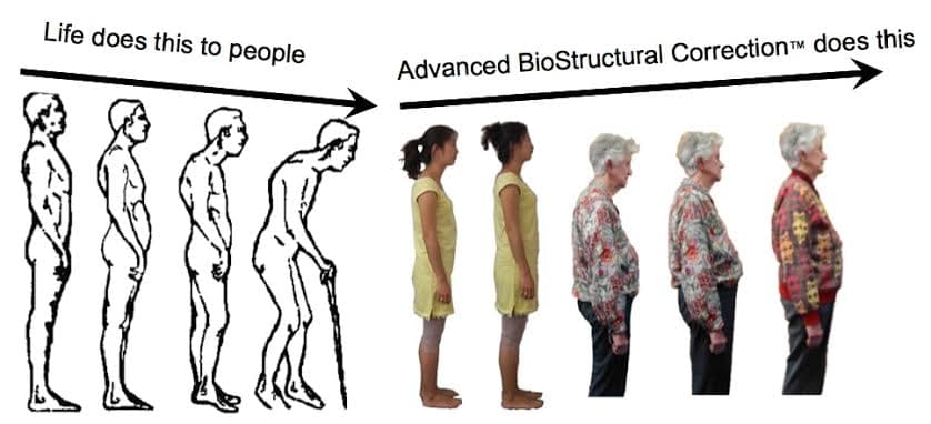 Life does this to people: five figures slumping further forward over time. Advanced Biostructural Correction does this: five photographs of a patient standing taller after each visit.