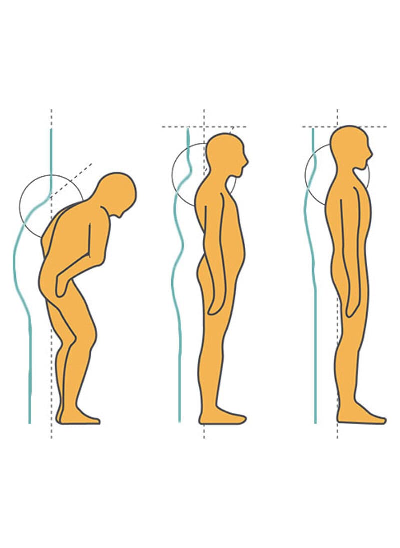 Three posture figures: stooped forward, partly corrected, and upright.