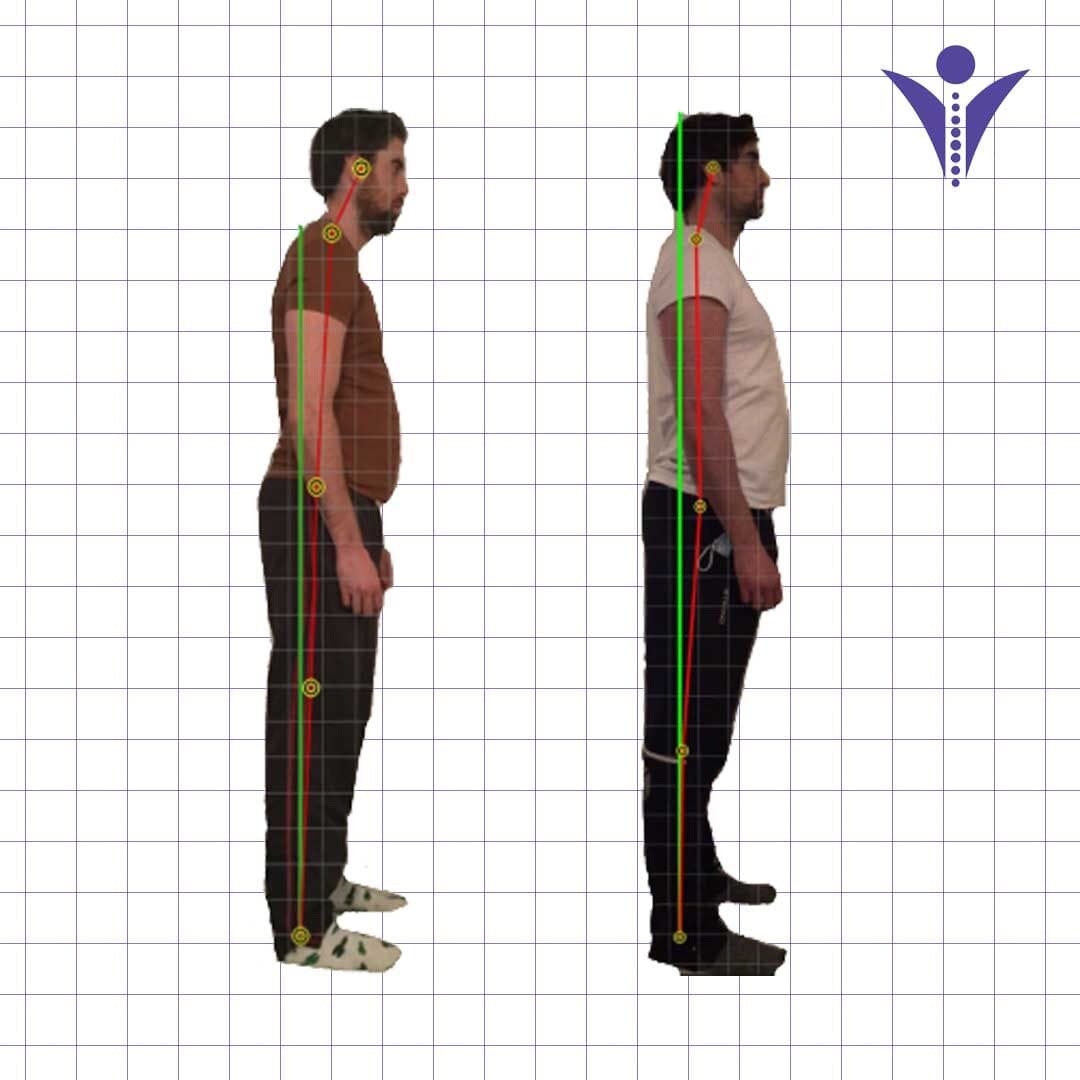 Alex's side-view posture photographs from two visits, on a measuring grid.