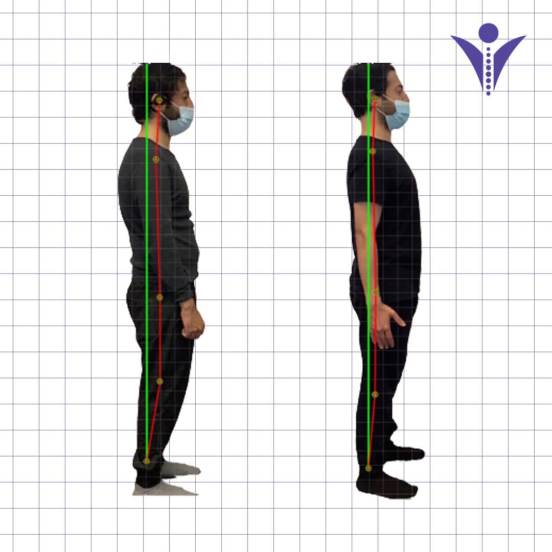 Ali's side-view posture photographs from two visits, on a measuring grid.