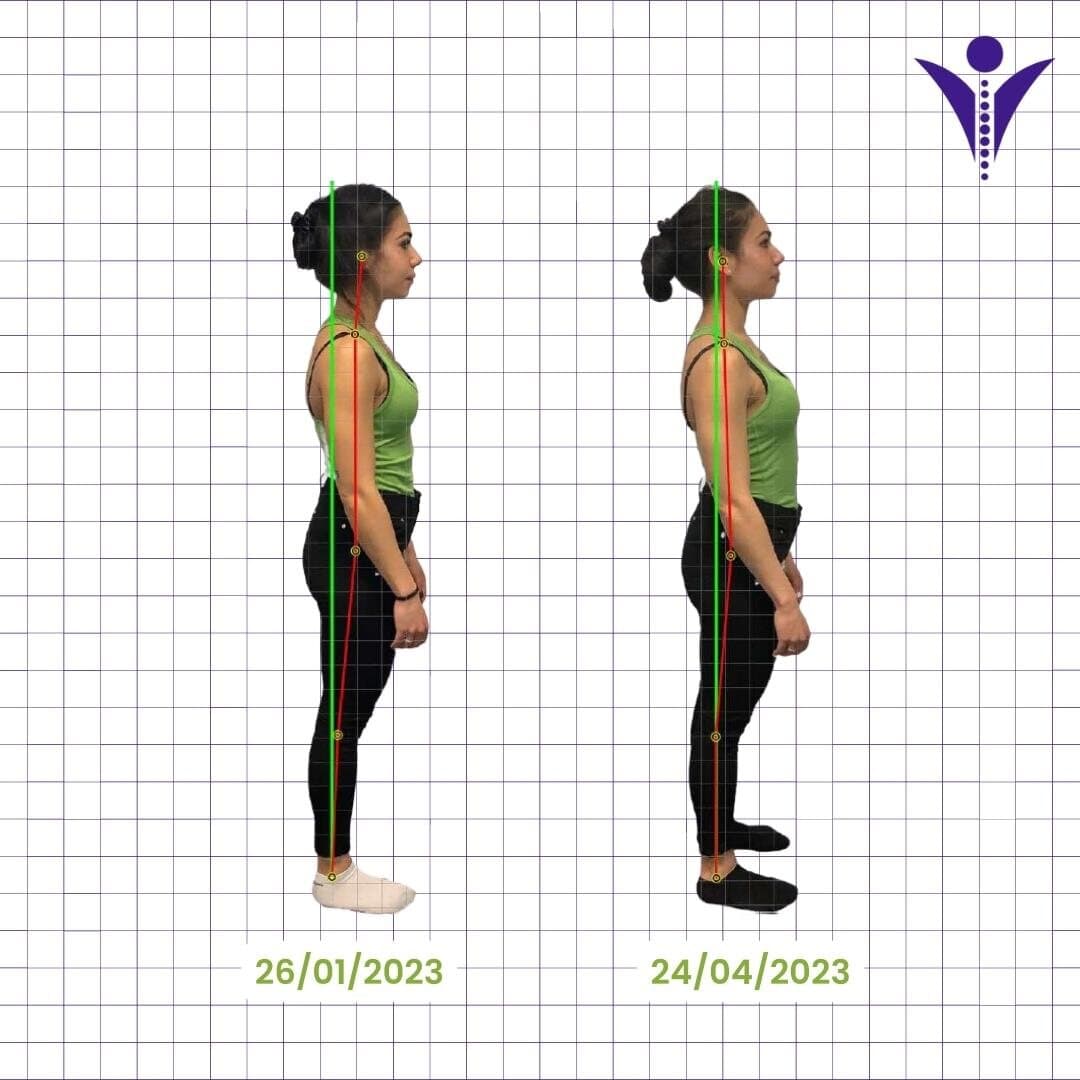 Chiara's side-view posture photographs from two visits, on a measuring grid.