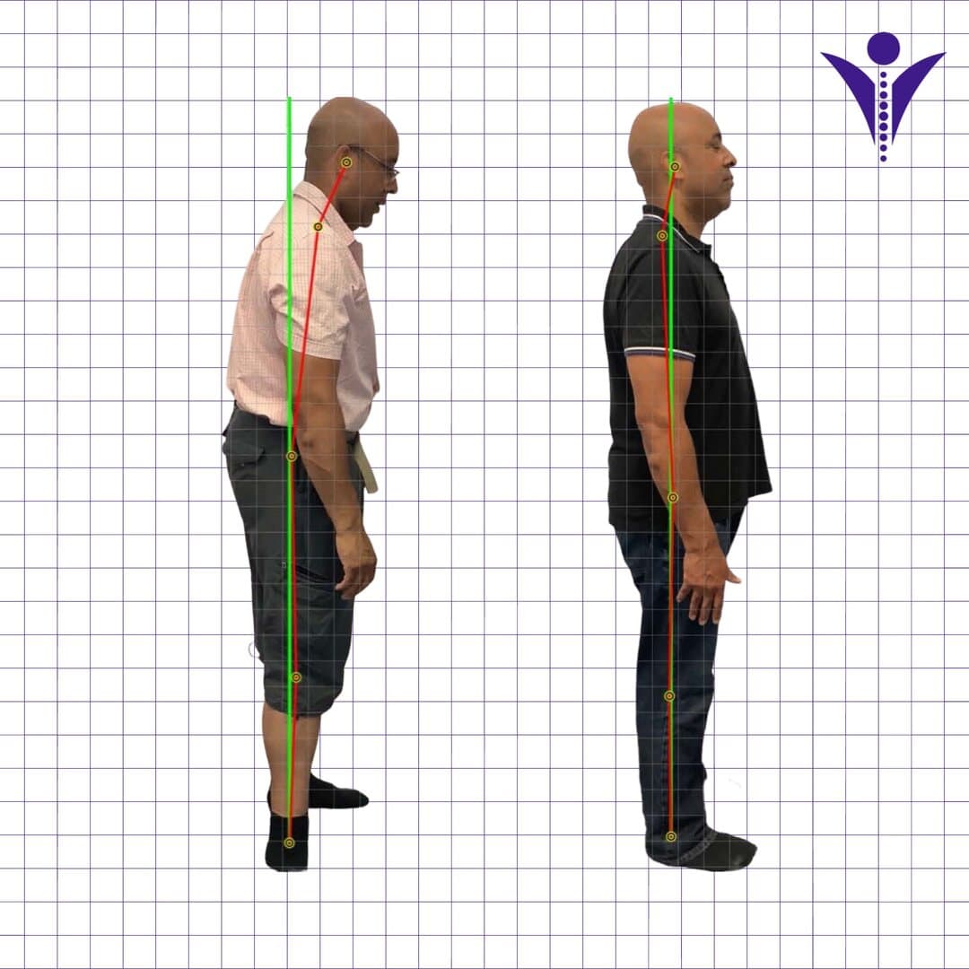 Derek's side-view posture photographs from two visits, on a measuring grid.