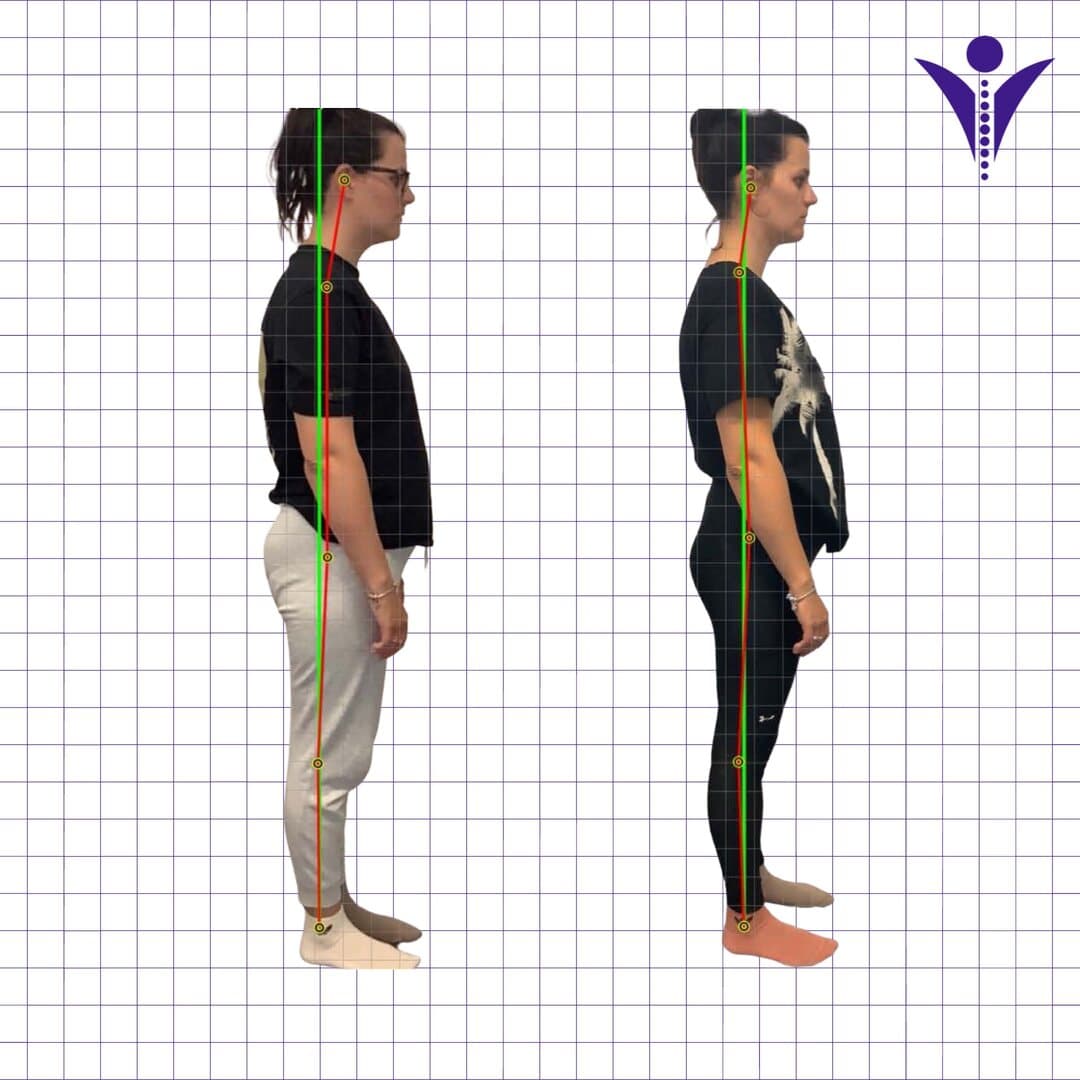 Olga's side-view posture photographs from two visits, on a measuring grid.