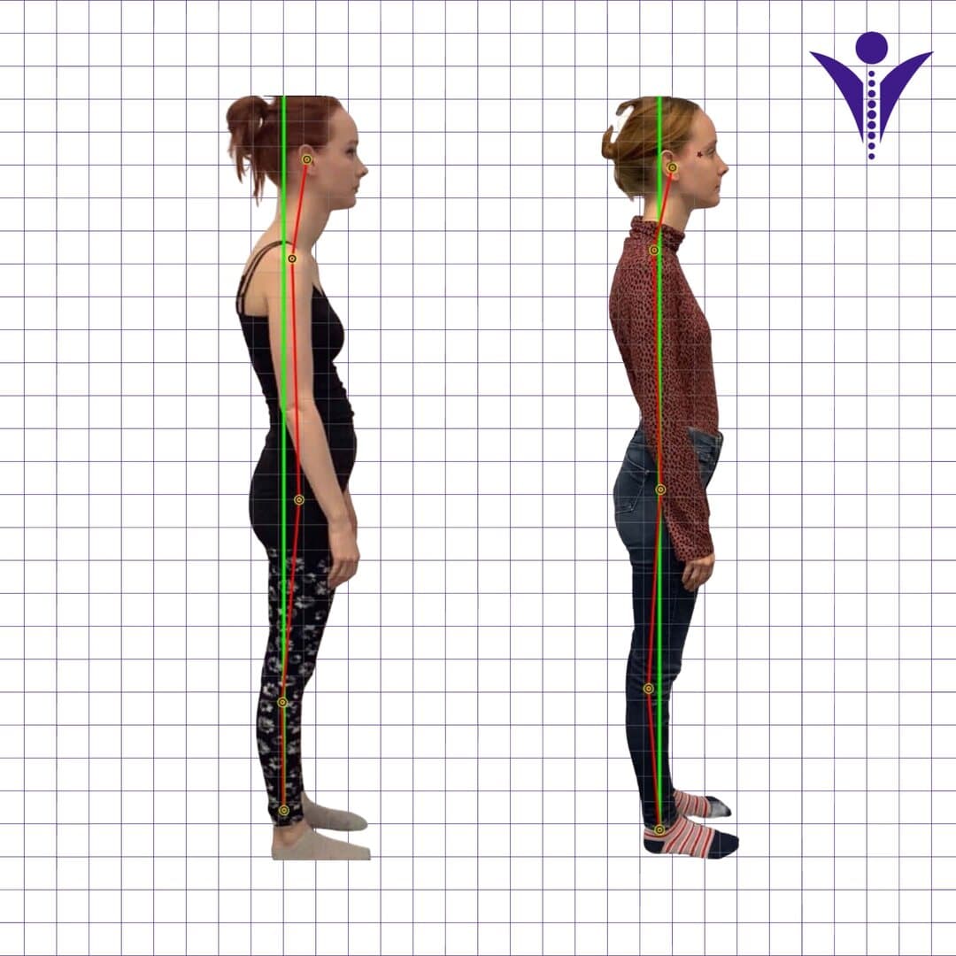 Stacie's side-view posture photographs from two visits, on a measuring grid.