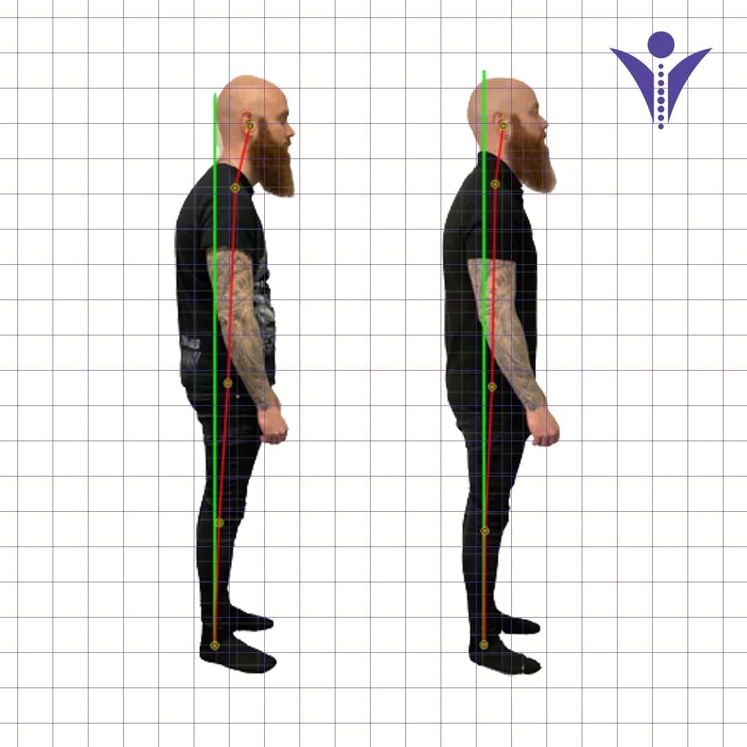 Trent's side-view posture photographs from two visits, on a measuring grid.
